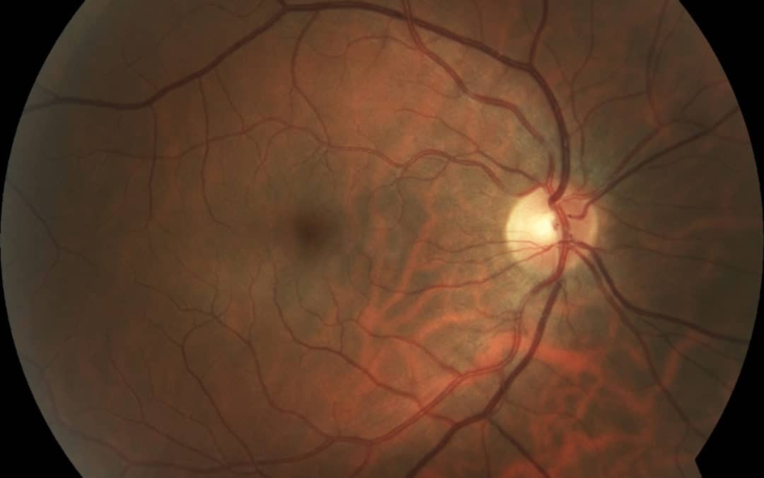 What we can see with retinal and optical coherence tomography imaging